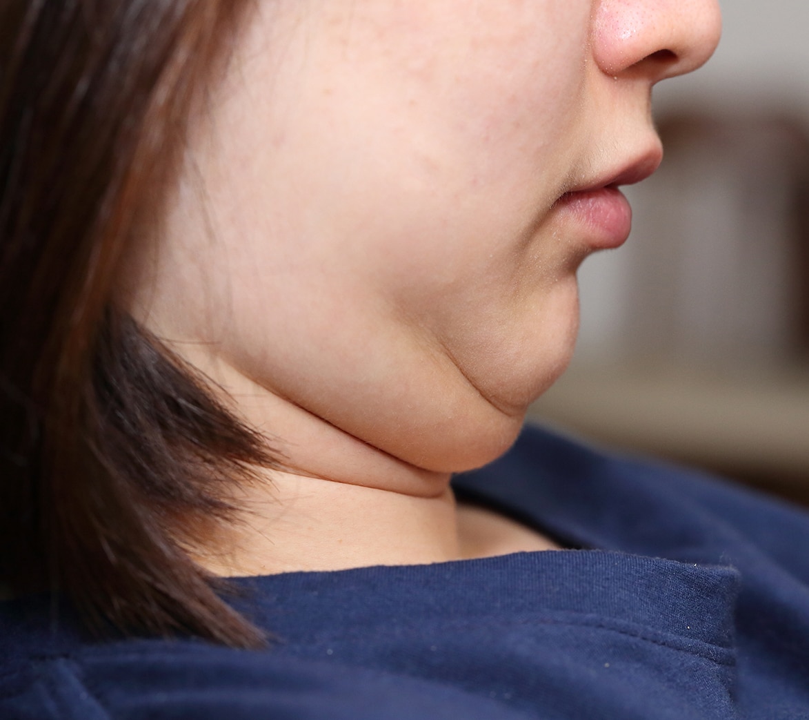 Double Chin Removal Liverpool