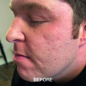 image of Acne Scarring Before