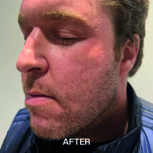 image of Acne Scarring After