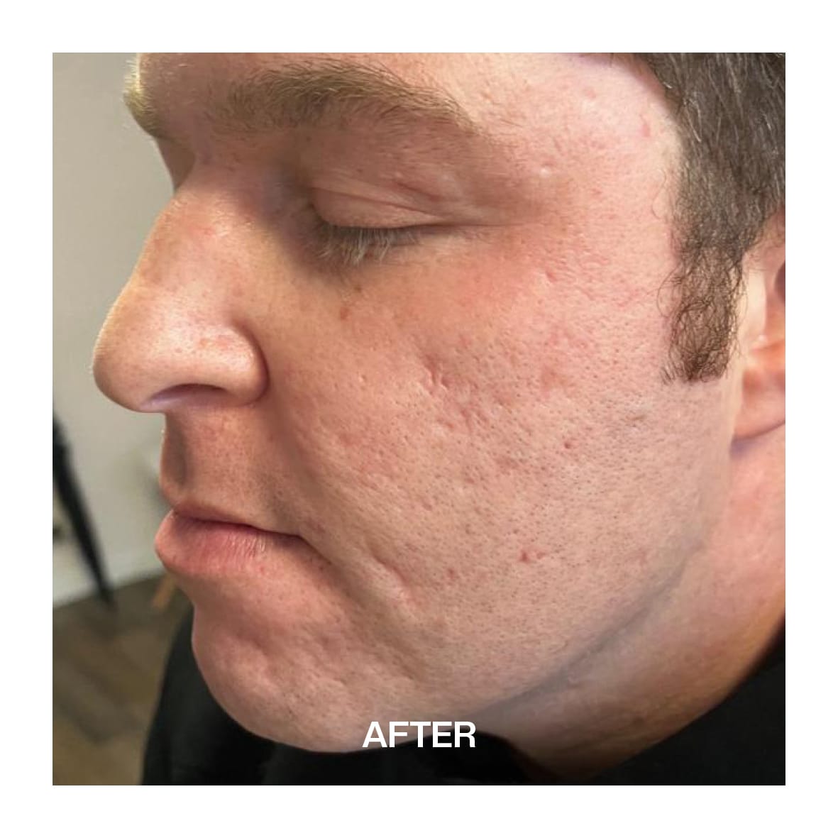 acne scar after image man
