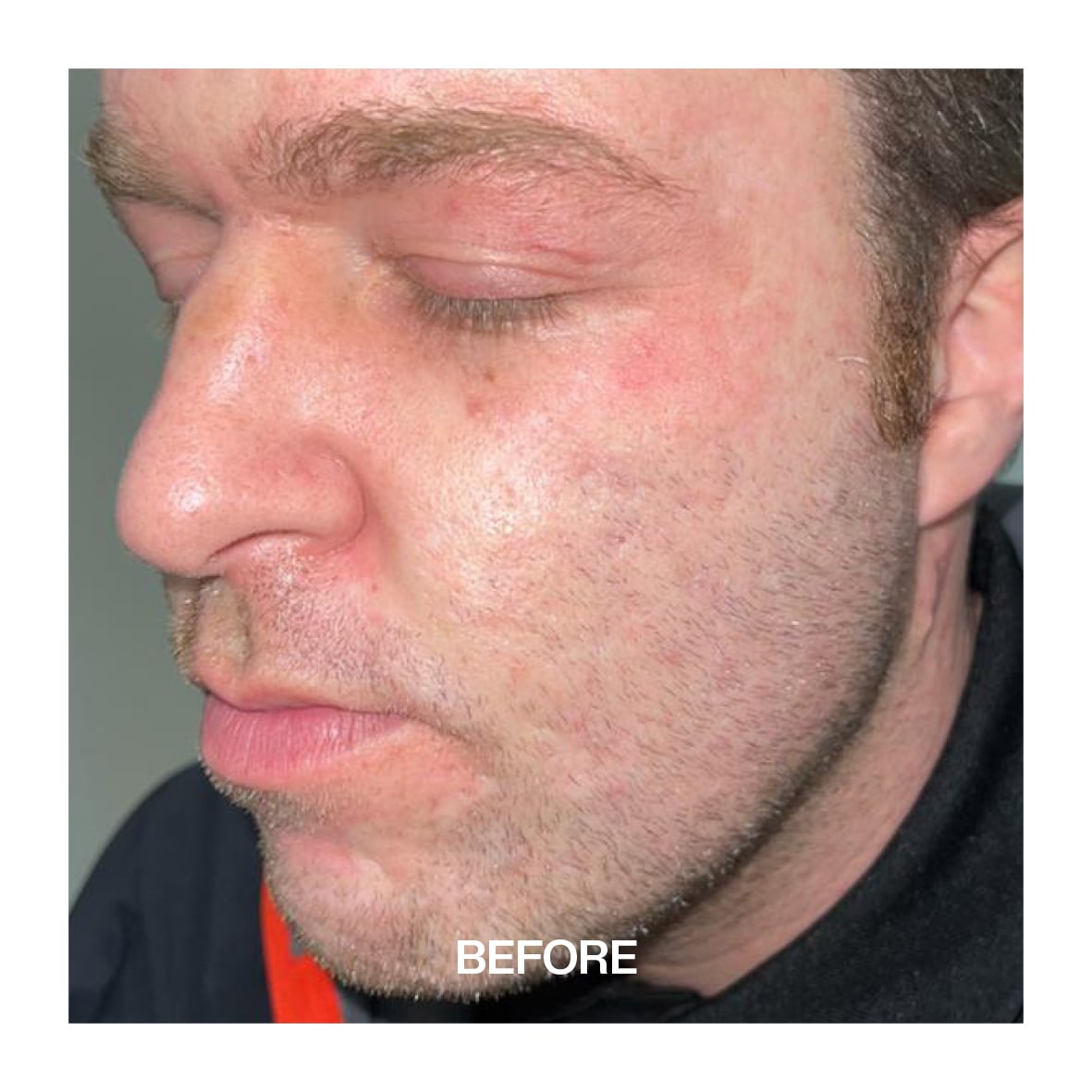 Acne Scar man before image