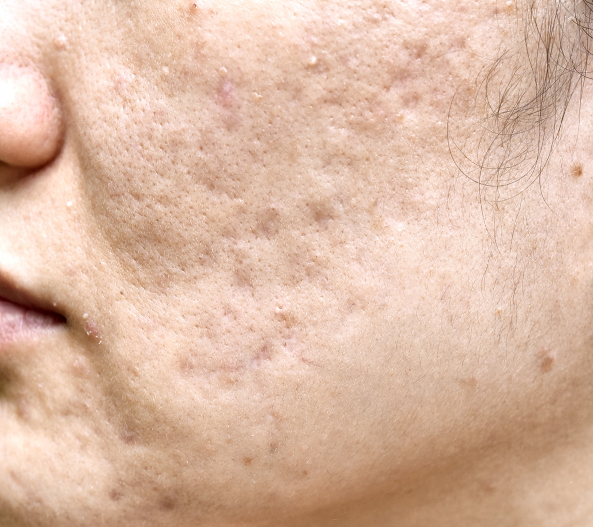 Acne scarring treatment