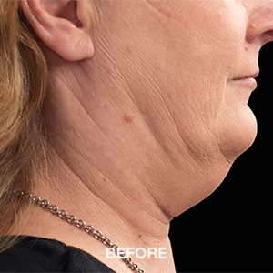 how to get rid of jowls without surgery